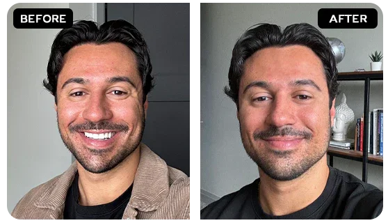 Sagging Jawline and Jowls