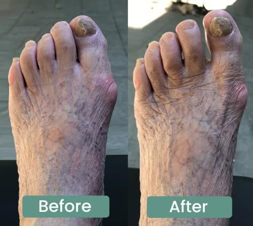 Zorveko Bunion Corrector – Adjustable Toe Alignment Support for Daily Comfort testimonials_HYFz9F:image:2