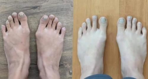 Zorveko Bunion Corrector – Adjustable Toe Alignment Support for Daily Comfort testimonials_HYFz9F:image:0